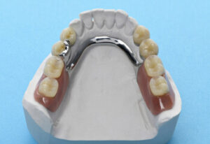 Read more about the article What Is a Cast Partial Denture? An In-Depth Guide