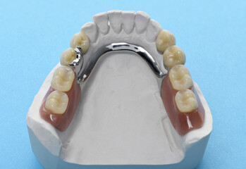 Read more about the article What Is a Cast Partial Denture? An In-Depth Guide