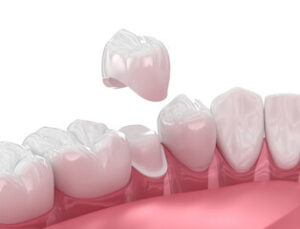 Read more about the article Types of Dental Crowns: Procedure and Benefits