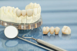 Read more about the article Crowns and Bridges: Difference and Best for You!