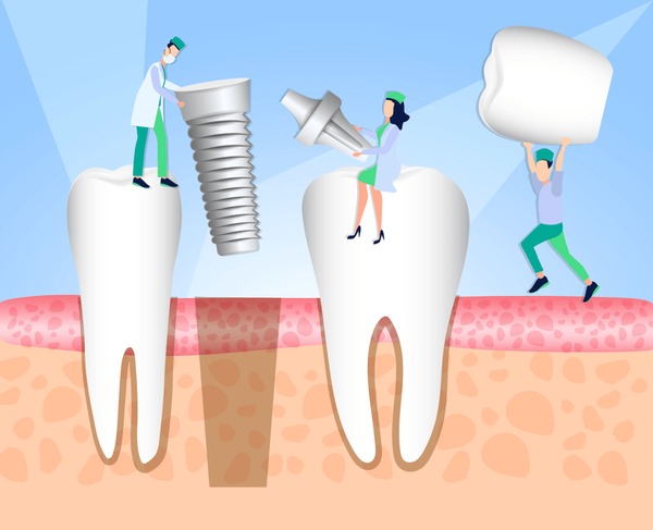 dental implant