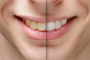 Read more about the article The Most Needed Smile Makeover for Wedding Season